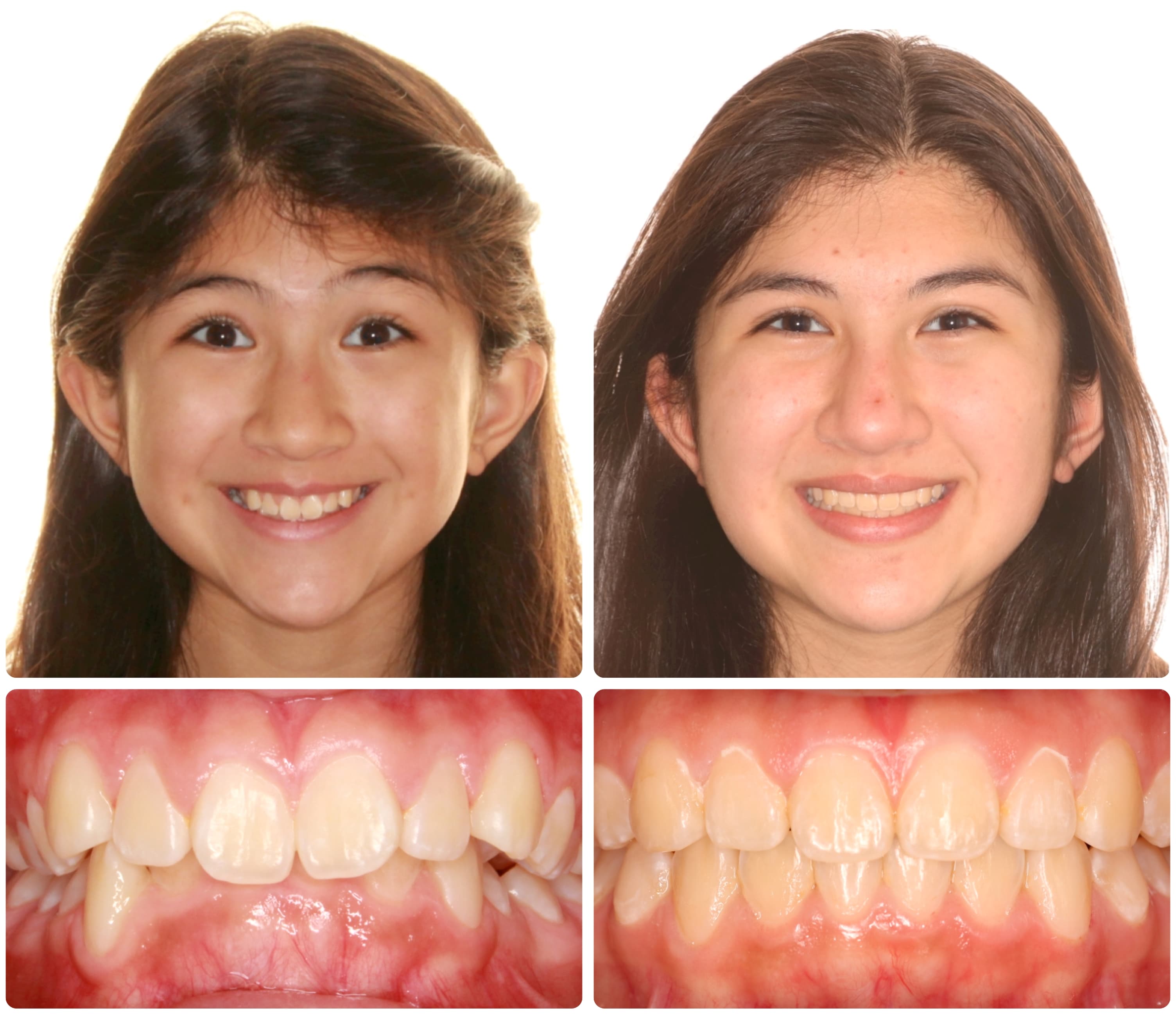 Before and after hybrid treatment results - facial and dental views