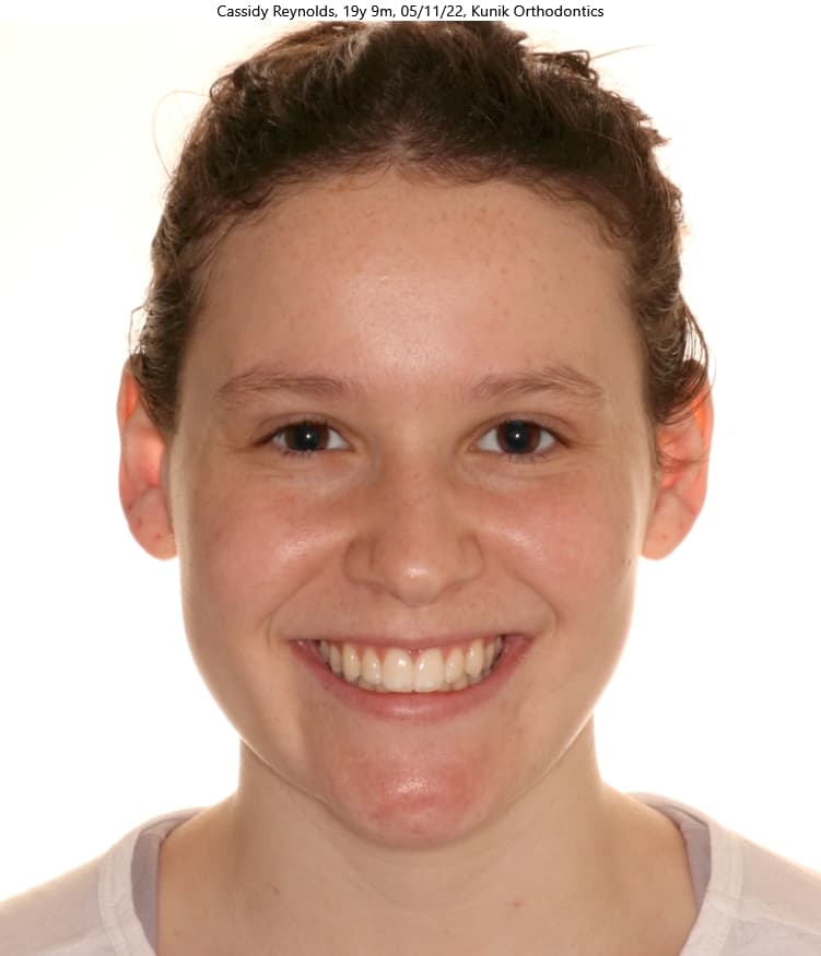 Cassidy after treatment