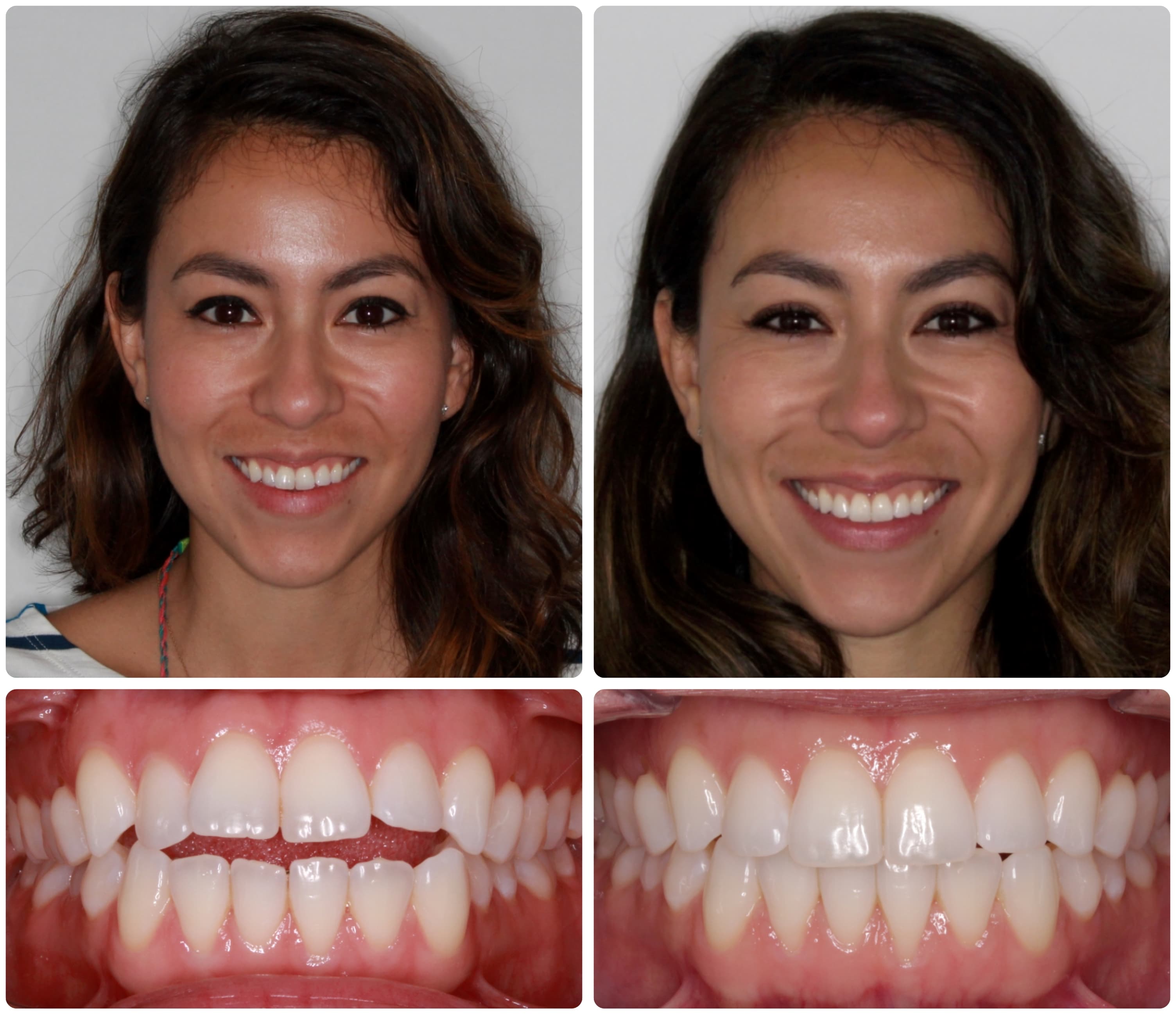 Before and after Invisalign treatment results - facial and dental views