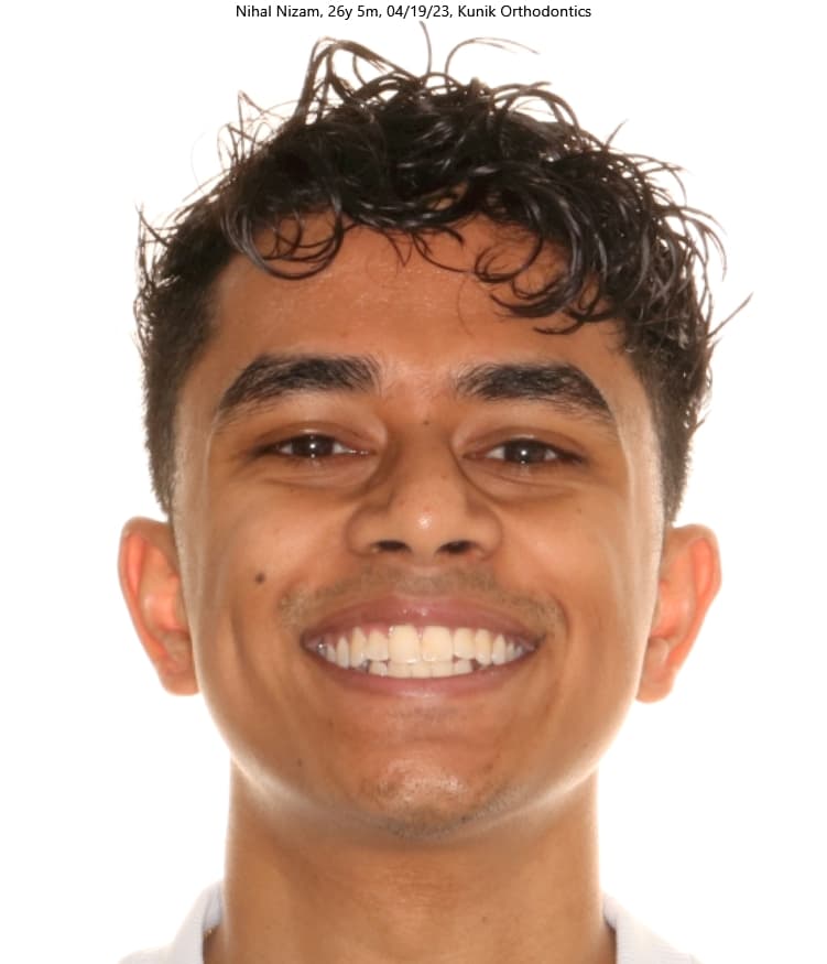 Nihal after treatment