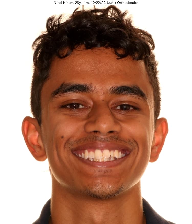 Nihal before treatment