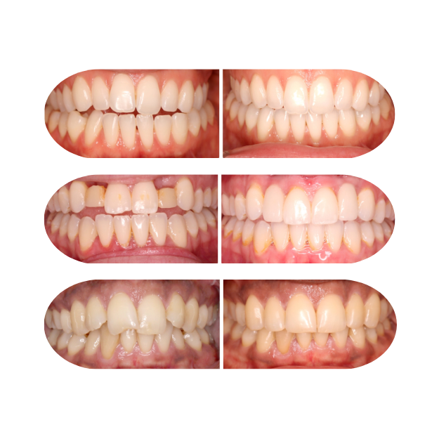 Expert braces treatment in Austin with patient-focused orthodontists.