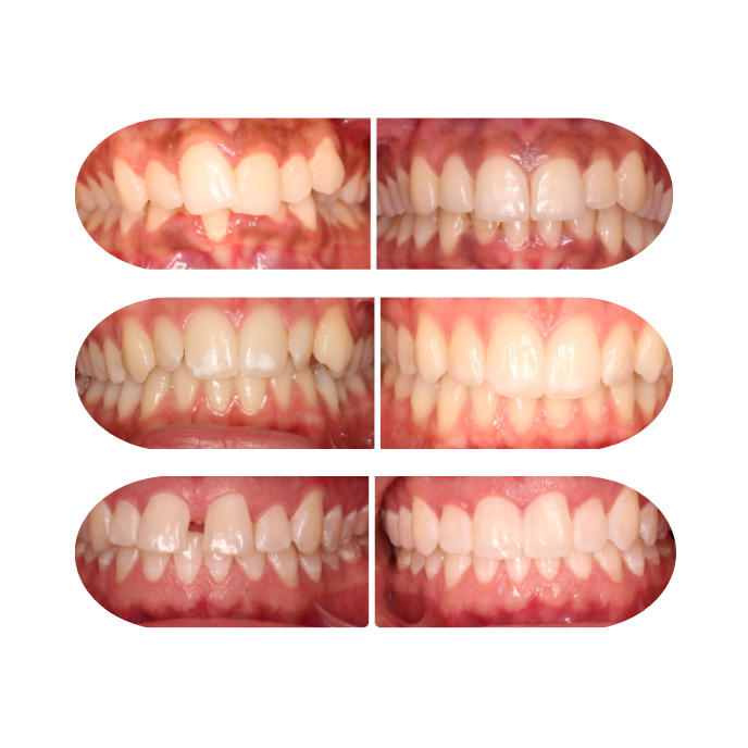 Invisalign in Austin designed to fit your smile and your budget.