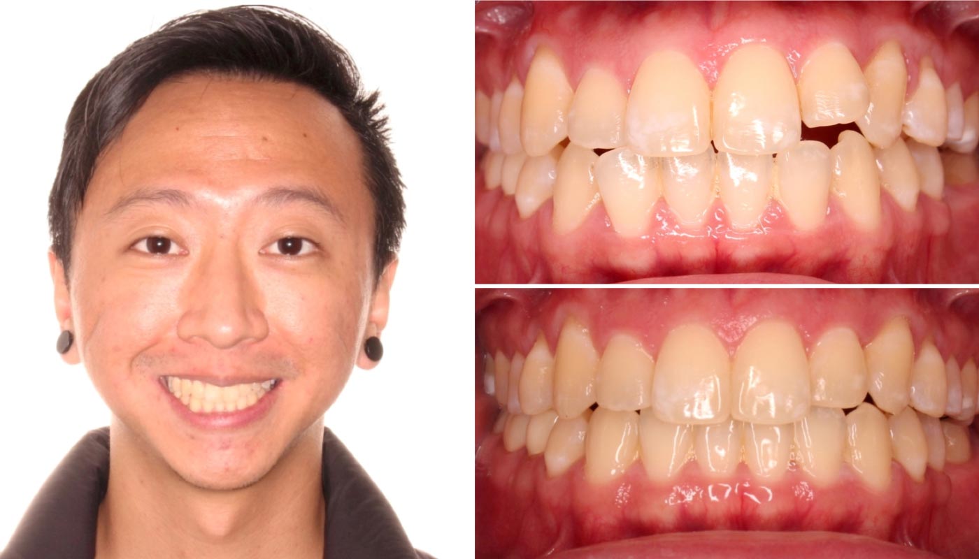 Personalized Invisalign care plans available in Austin TX for straighter teeth.