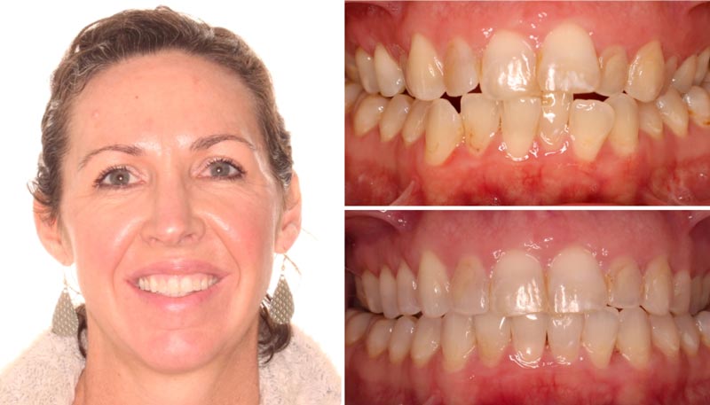 Discreet Invisalign treatment available for adults and teens in Austin.