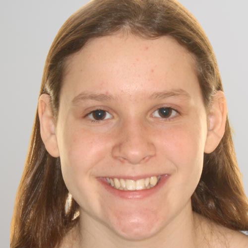Smile transformation using braces by a skilled Austin orthodontist.