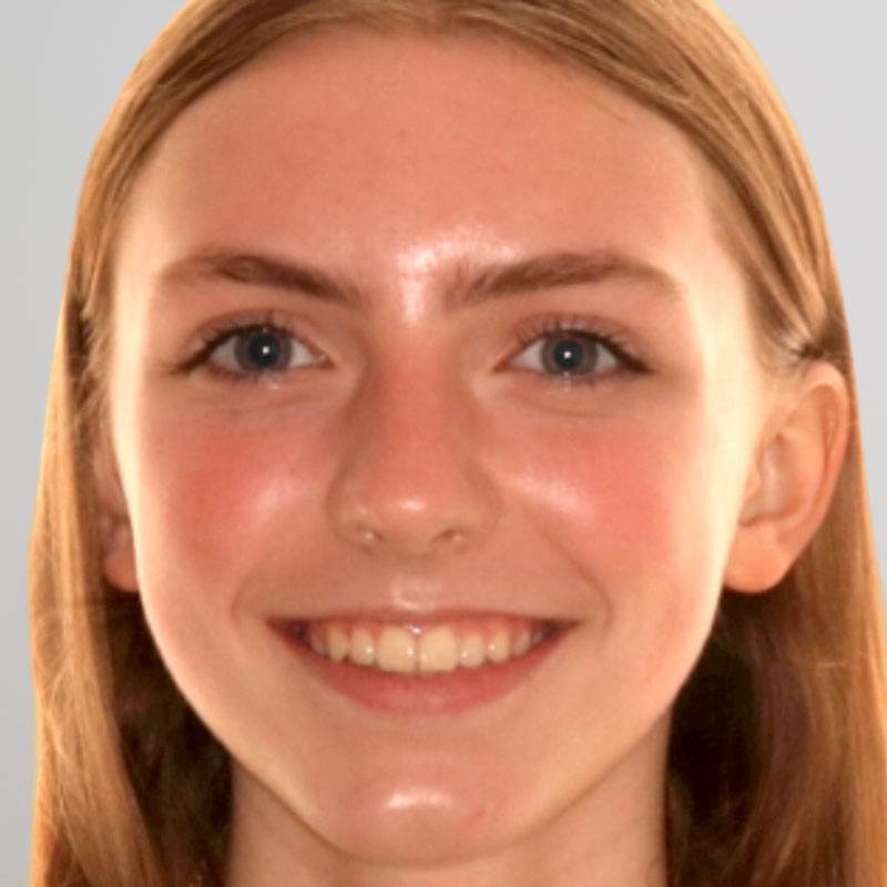Clear aligners in Austin TX available for a subtle and effective smile makeover.