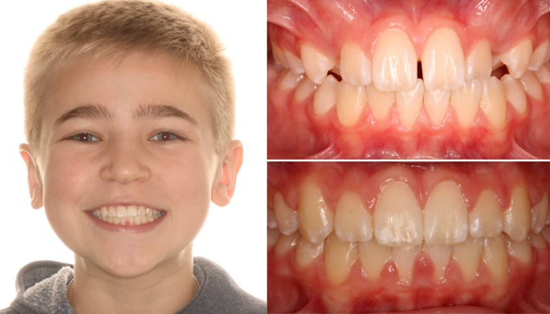 Explore braces options in Austin with experienced orthodontic professionals.
