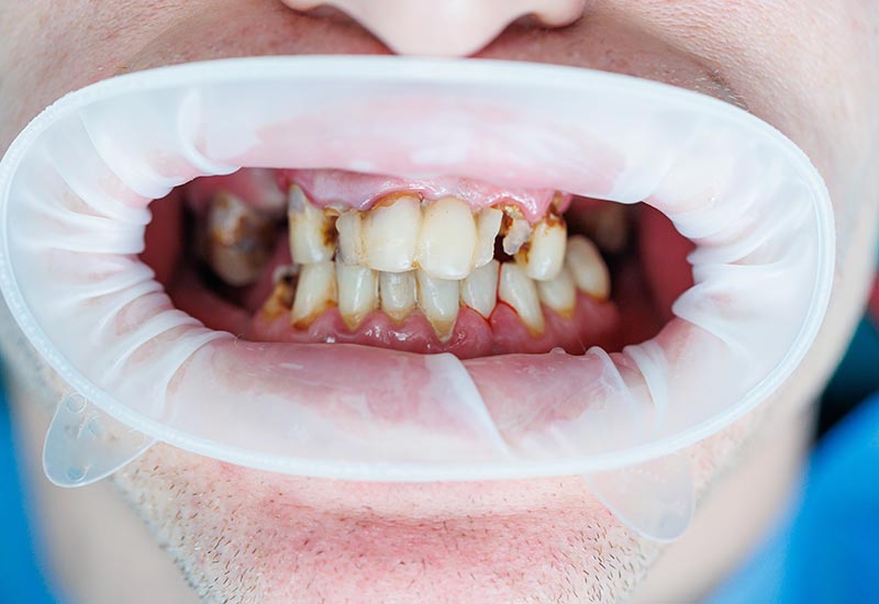 Effects-of-Sugar-on-Teeth