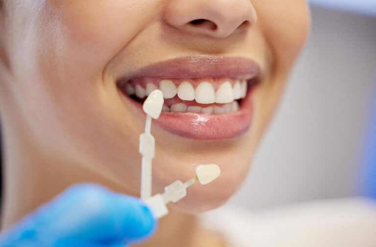 Why Do People Get Veneers?