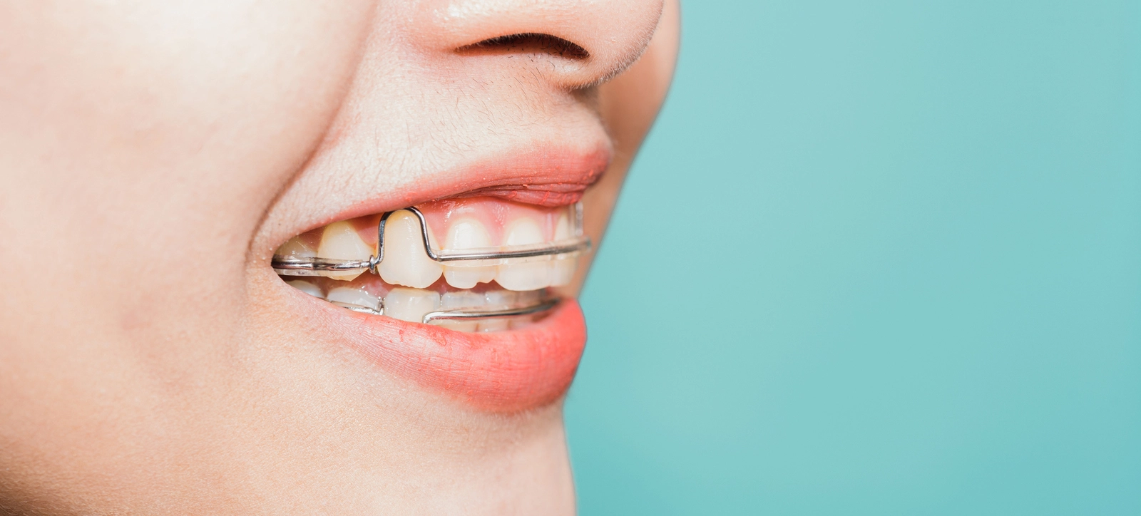 Orthodontic Retainers